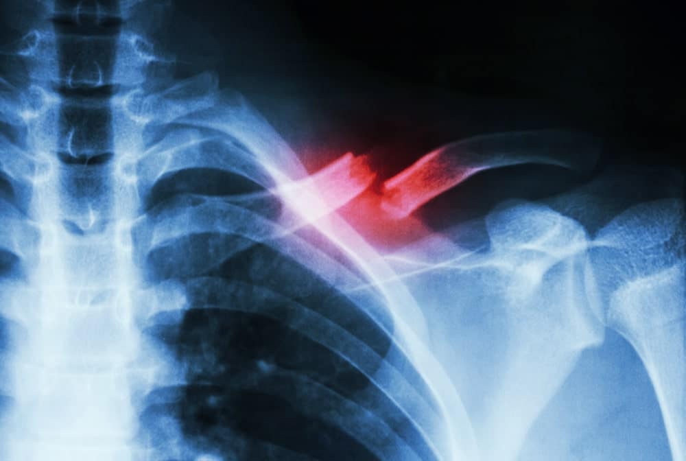 9-11 Acute Traumatic Injury Compensation Claim portrayed by an x-ray of a person with broken bone fractures.