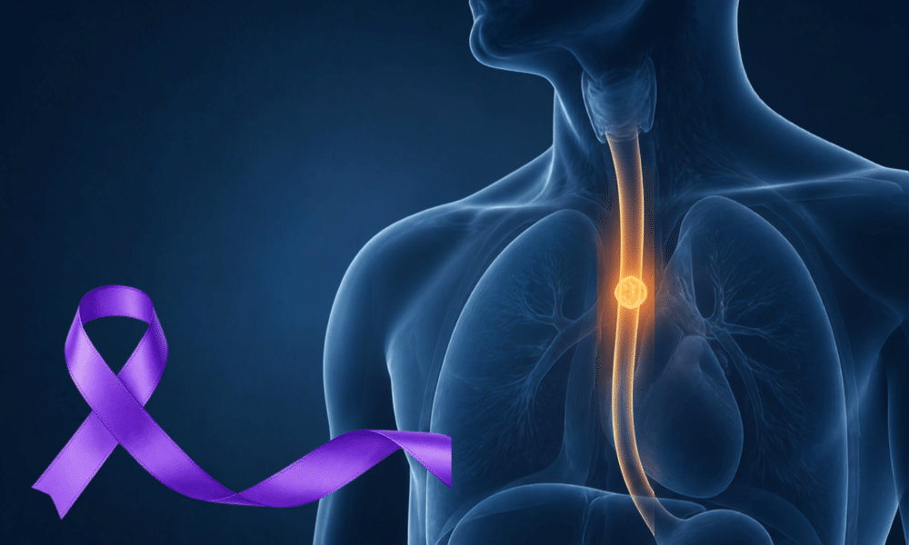 Esophageal Cancer Claims For 9-11 Survivors